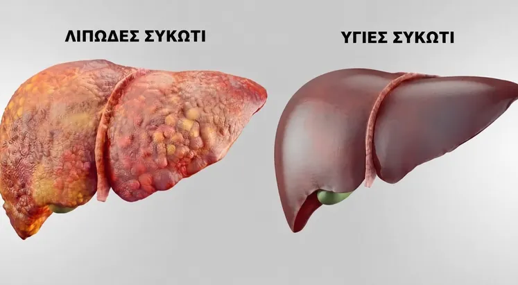 Ένα λιπώδες συκώτι δίπλα σε ένα υγιές συκώτι